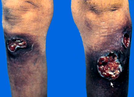 三期梅毒疹(梅毒性树胶肿)_医学教育网