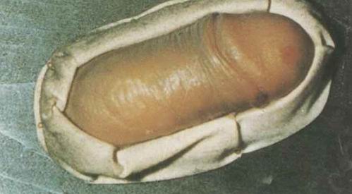 性病性淋巴肉芽肿(1)_医学教育网