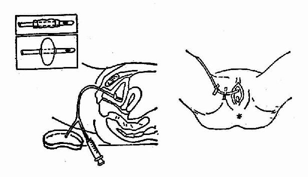 第二节 <em>泌尿</em>道常用的护理技术