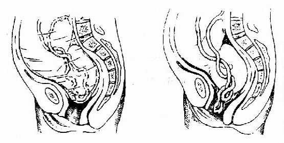 胎膜破裂,脐带<em>脱出</em>于宫颈口外者