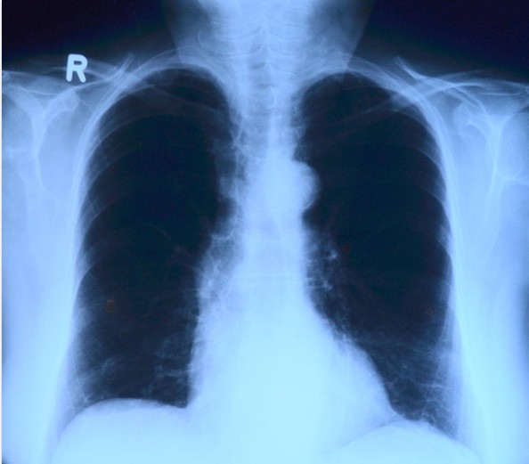 肺结核要做的常规检查及辅助检查都有什么