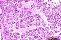 甲状腺机能亢进