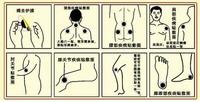 膏药贴敷示意图