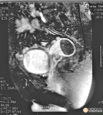 �ӹ�����MRI