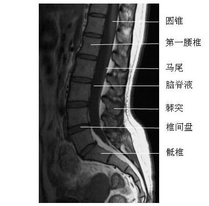 腰段正中矢状面-mri