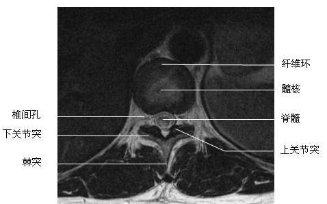 �ضκ����-MRI