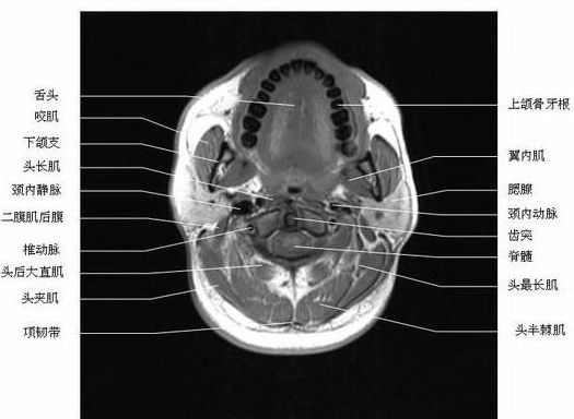 ͷ���������-MRI