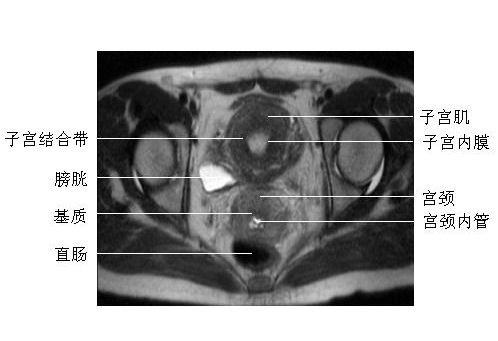 Ů����ǻ�����-MRI