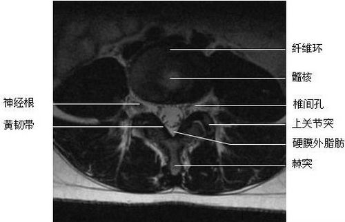 腰段横断面解剖图-mri