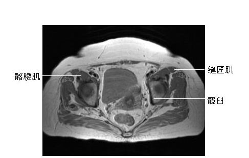 �Źؽں����-MRIͼ