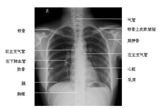 胸部正位x线图片