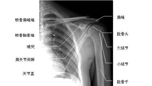 肩关节x线平片图图片
