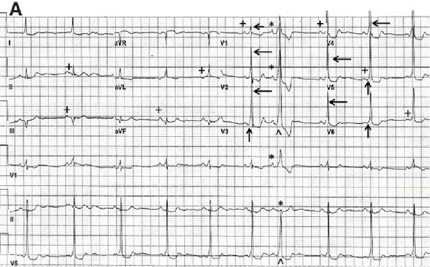 心电图挑战-房室折返性心动过速的正逆之辨