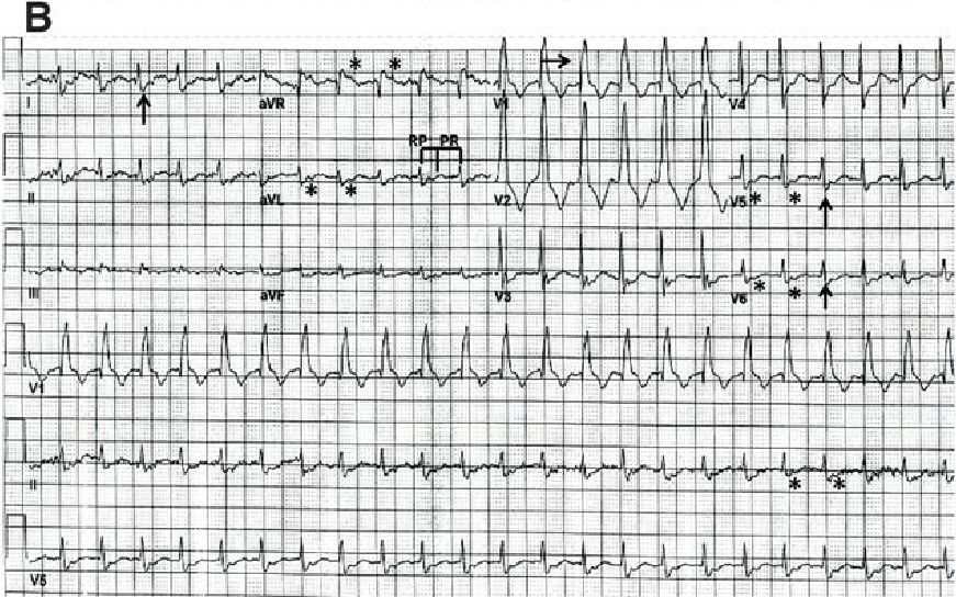 心电图挑战-房室折返性心动过速的正逆之辨