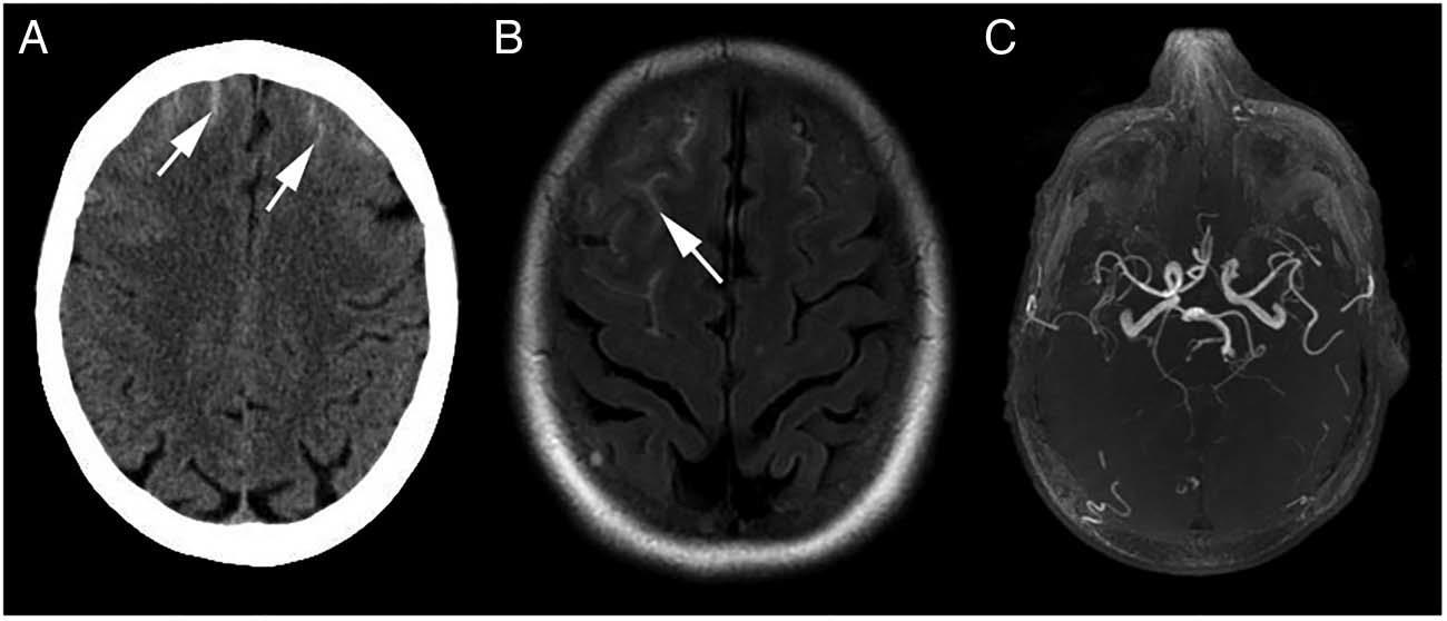 突发雷击样头痛-警惕皮层静脉血栓形成