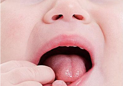 口腔溃疡应该如何预防以及食疗方式有哪些?