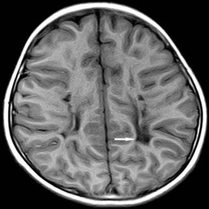 小儿脑瘫的常见类型及早期诊断方法