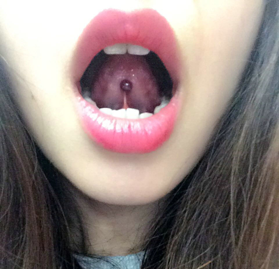 口腔溃疡的治疗目前常用的三种方法