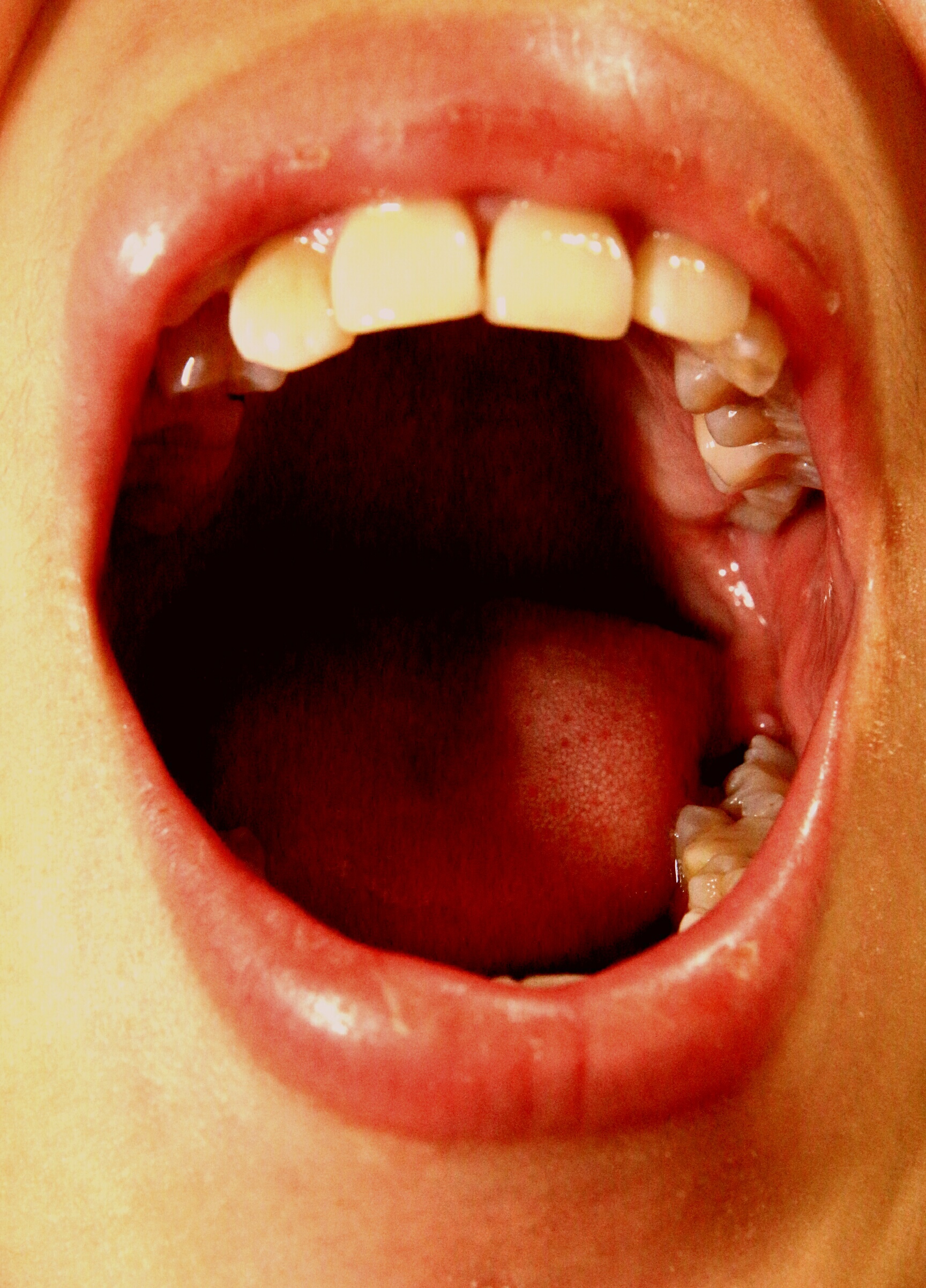 牙龈溃疡图,牙龈溃疡图片_大山谷图库
