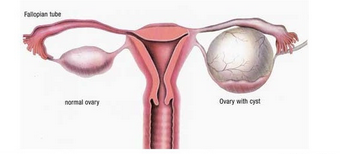 卵巢囊肿