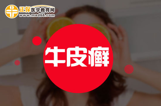 普通不太严重的牛皮癣能治好吗？