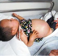 2019年中西医执业医师重要考点之急性肾小球肾炎临床表现