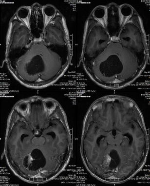 头部MRI分析