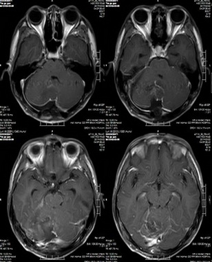 头部MRI分析