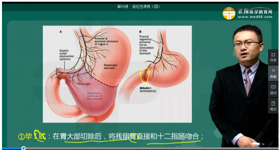 毕Ⅰ式胃大部切除术 