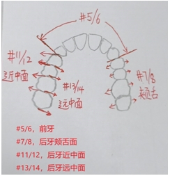 gracey刮治器 口诀图片