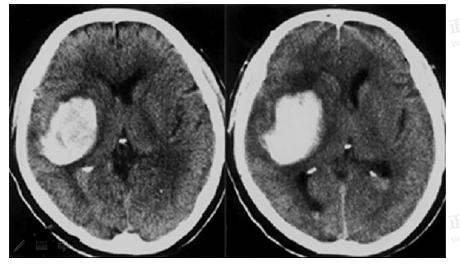 男55岁,左侧肢体偏瘫4小时,有高血压史,诊断为 男55岁,左侧肢体偏瘫4小时,有高血压史,诊断为