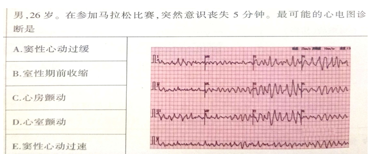 心室颤动 心室颤动