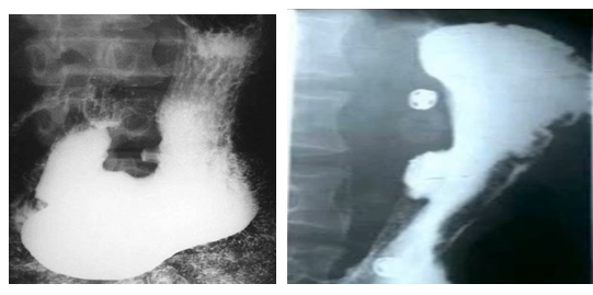 男性,55岁,上腹隐痛约十年,请做出正确诊断 男性,55岁,上腹隐痛约十年,请做出正确诊断