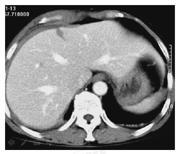 患者,女性,20岁。胸腹部被车撞伤5小时。诊断为 患者,女性,20岁。胸腹部被车撞伤5小时。诊断为