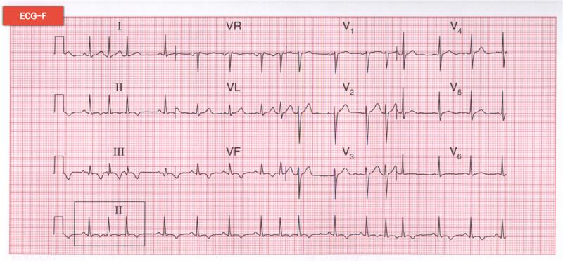 房性期前收缩 房性期前收缩