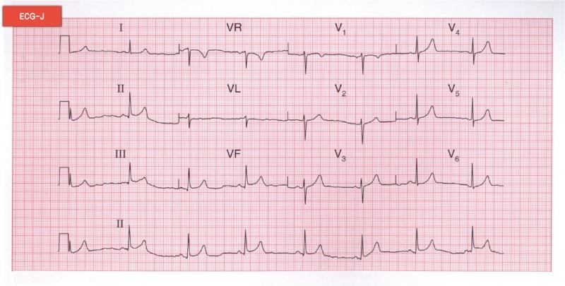 心动过缓 心动过缓