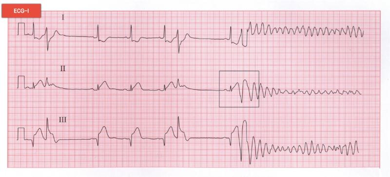 心室颤动 心室颤动