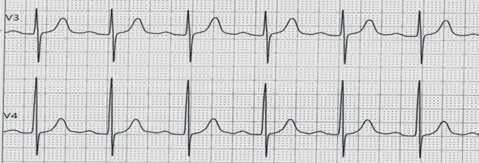 临床助理医师实践技能考试练习题一度房室传导阻滞心电图