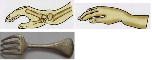 2021临床助理医师笔试6个骨折考点及记忆口诀