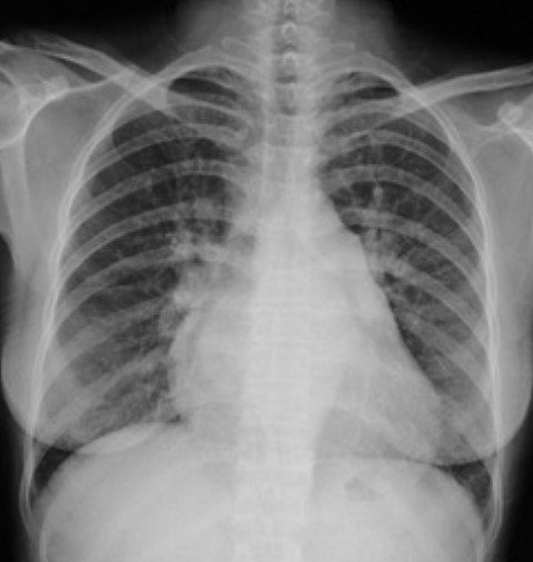 2023年临床技能第一站影像诊断：X线-心脏增大（二尖瓣型、主动脉型和普大型）