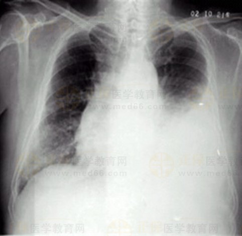 临床执业医师实践技能测试题诊断（X线-胸腔积液）