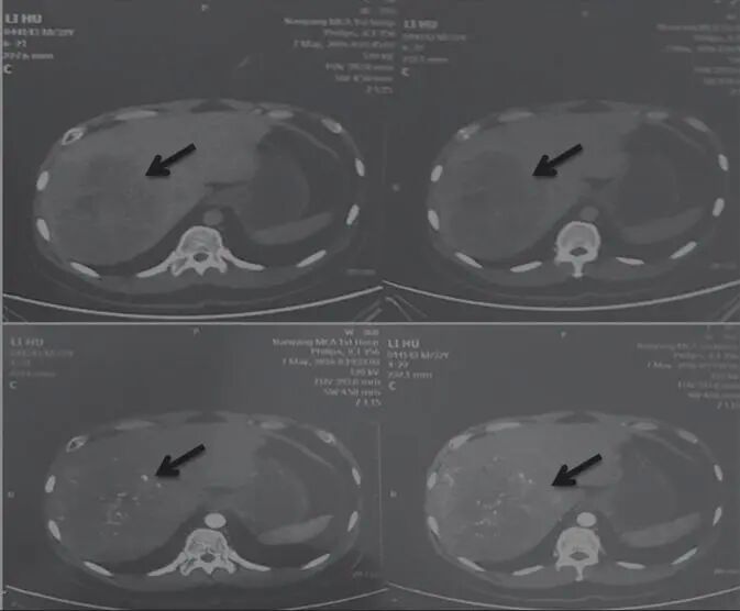 图1 舒达少阳防治肿瘤验案初诊CT结果