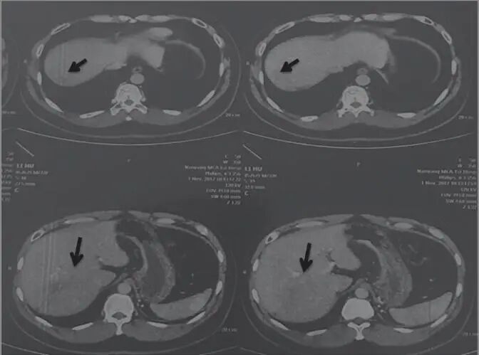 图2 舒达少阳防治肿瘤验案2017年11月1日CT结果