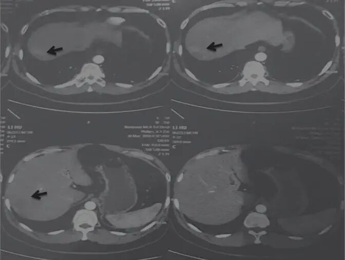 图3 舒达少阳防治肿瘤验案2018年3月30日CT结果