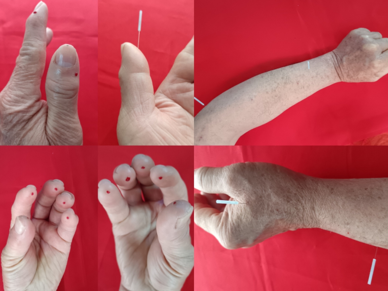 陈氏手针讲急救